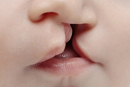 Stem Cells May Hold the Key to Helping Patients with Cleft Palate