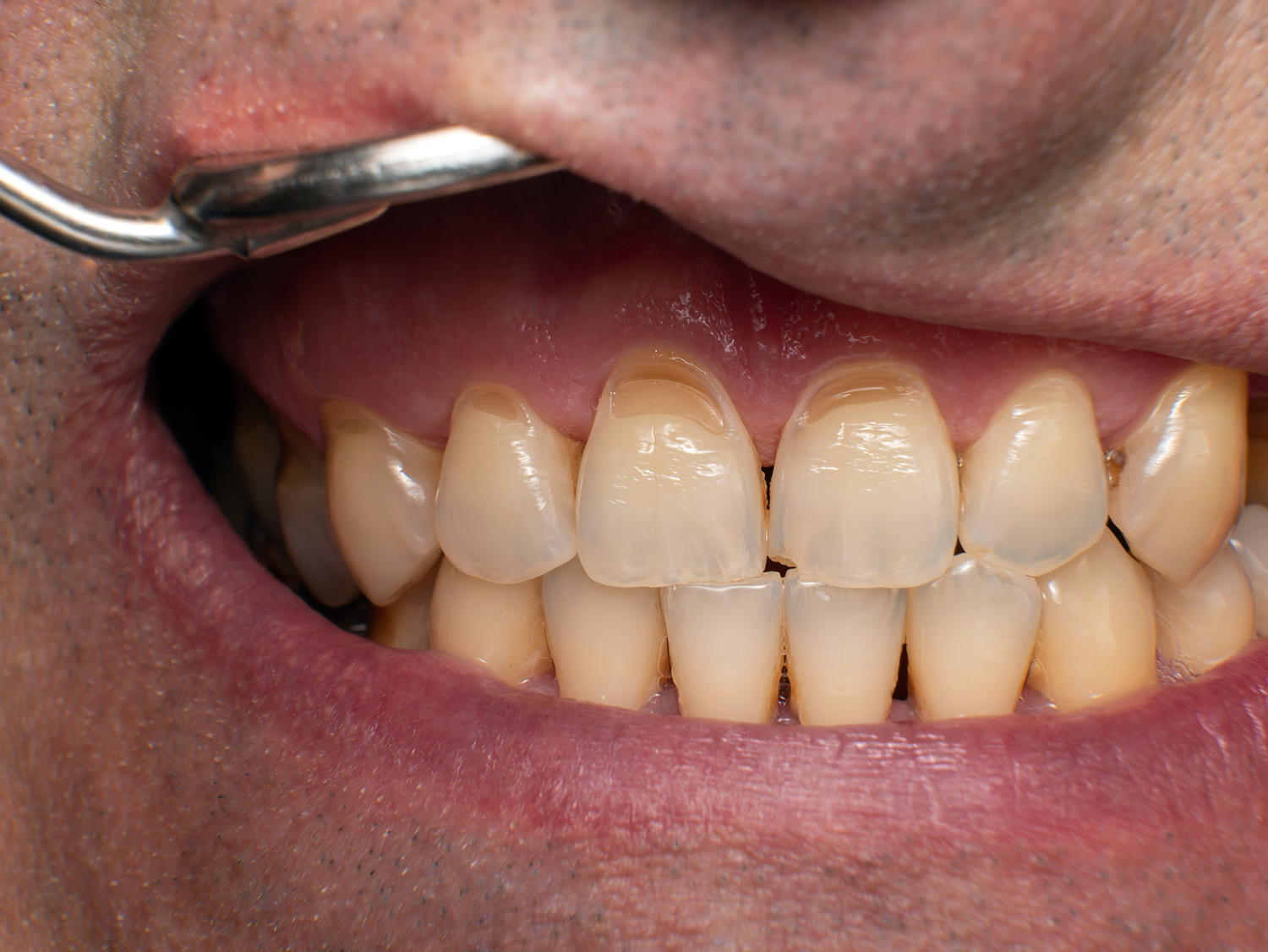 Maxillary front teeth with wedge-shaped cervical defects on all incisors, one fractured incisor, and generalized dental plaque covering all teeth